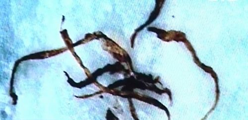 Η νόσος Morgellons υπάρχει και μπορεί να σχετίζεται με ΓΤΟ