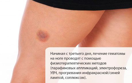 Θεραπεία αιματώματος στο πόδι