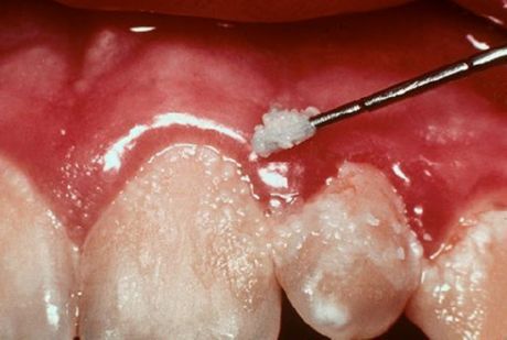 Δόντια και ουλίτιδα